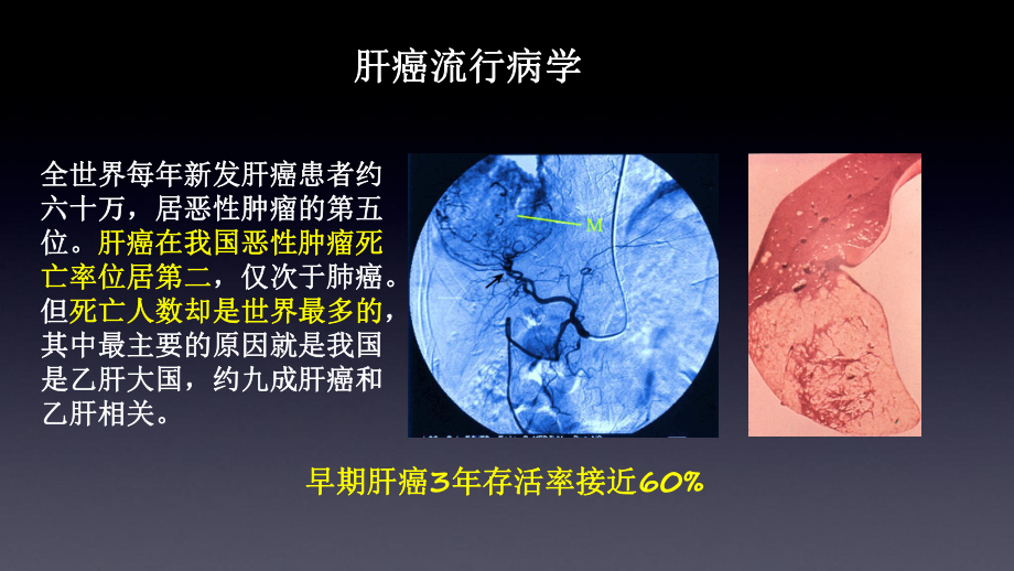 肝脏病灶双期GSI检查分析诊断课件.ppt_第2页