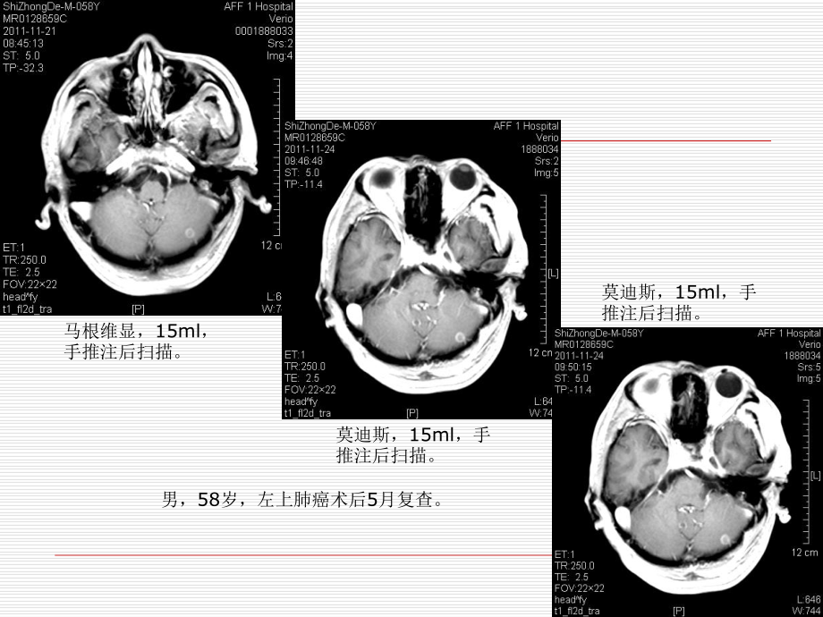 莫迪斯与马根维显增强扫描对脑转移病灶显示的差异课件.ppt_第2页