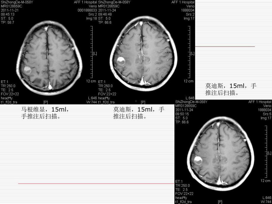 莫迪斯与马根维显增强扫描对脑转移病灶显示的差异课件.ppt_第3页