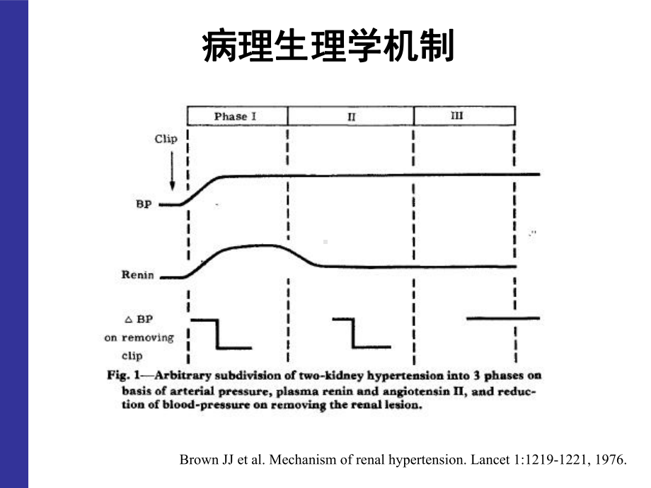 肾动脉狭窄课件.ppt_第3页