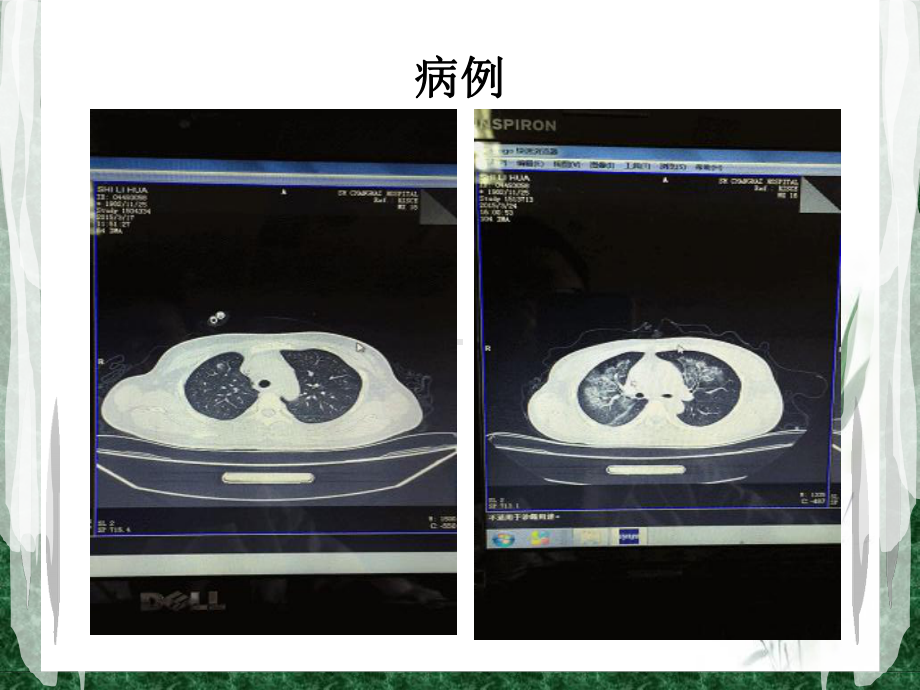 胸部读片-肺出血肾炎综合征课件.ppt_第3页