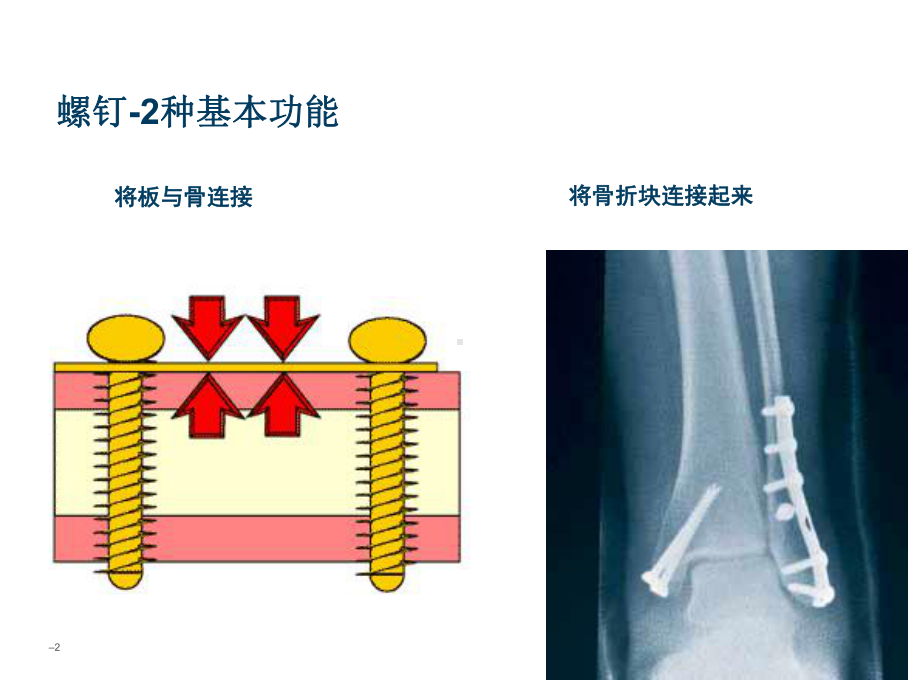 骨科基础-螺钉设计与类型课件.pptx_第2页