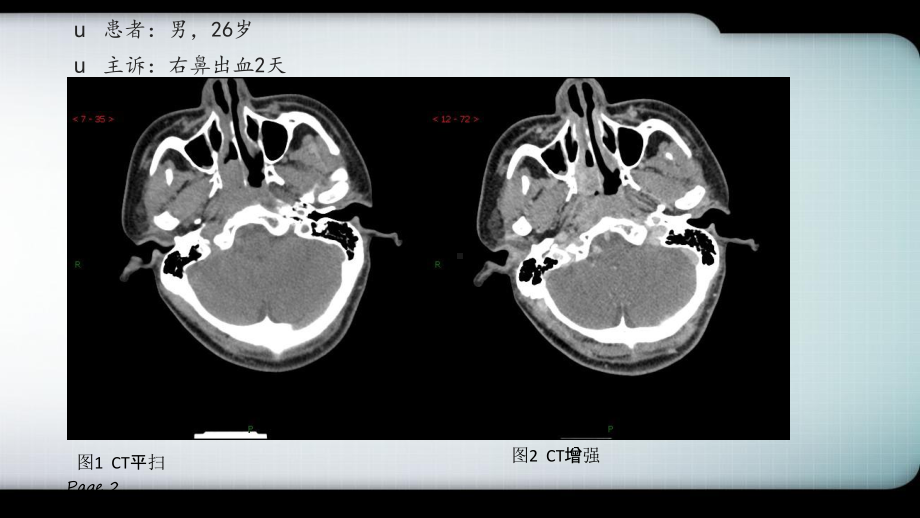 鼻咽纤维血管瘤的影像表现及临床医学PPT课件.ppt_第2页