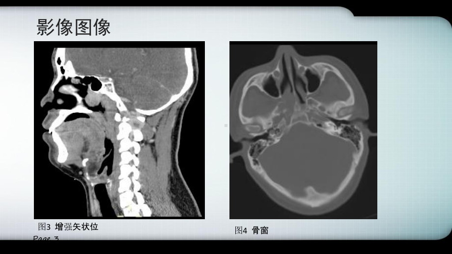 鼻咽纤维血管瘤的影像表现及临床医学PPT课件.ppt_第3页