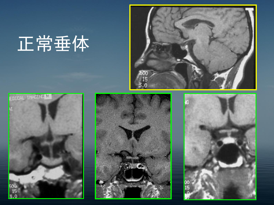 鞍区病变的CT及MRI诊断课件.ppt_第3页