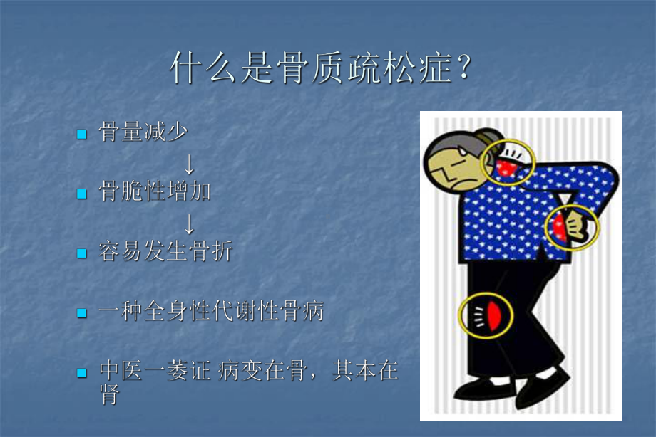 骨质疏松症医学PPT课件.ppt_第2页