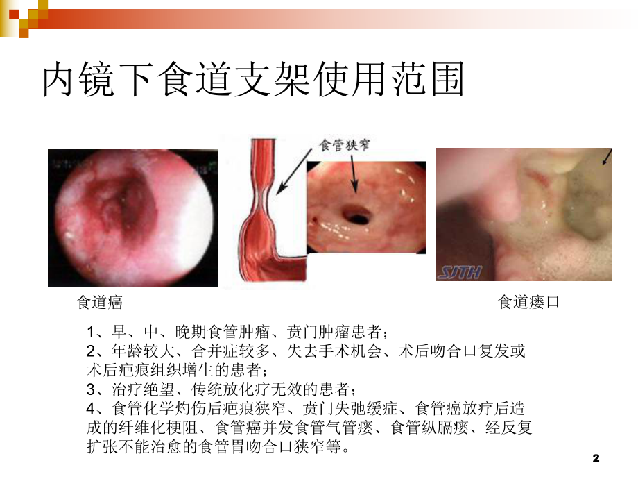 食道支架医学PPT课件.ppt_第2页