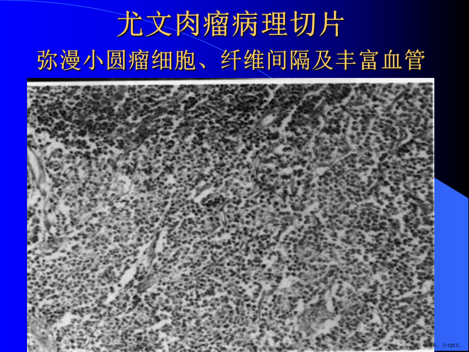 常见骨肿瘤影像诊断分析-5(其它)课件(PPT 125页).pptx_第3页