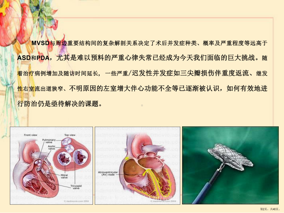 儿童室间隔缺损介入治疗的挑战课件(PPT 40页).pptx_第2页