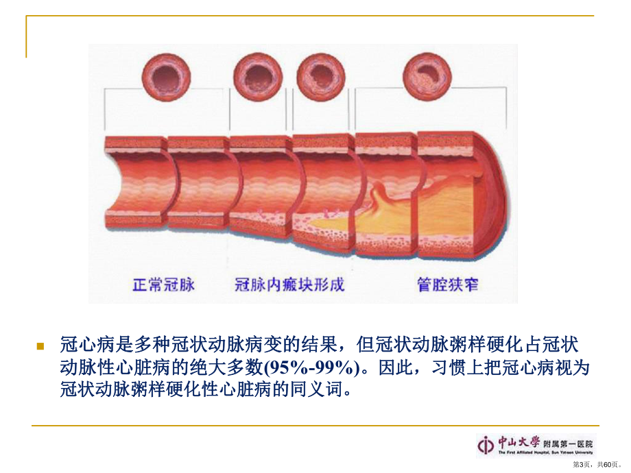 冠心病外科治疗现状 课件(PPT 60页).pptx_第3页