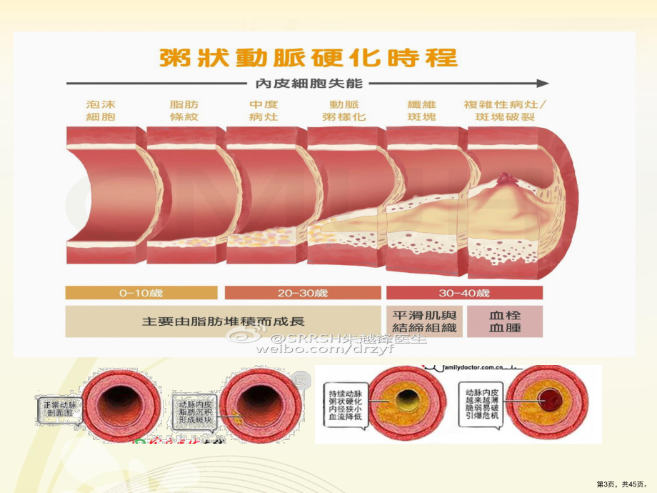 心肌梗塞护理查房PPT课件(PPT 45页).pptx_第3页