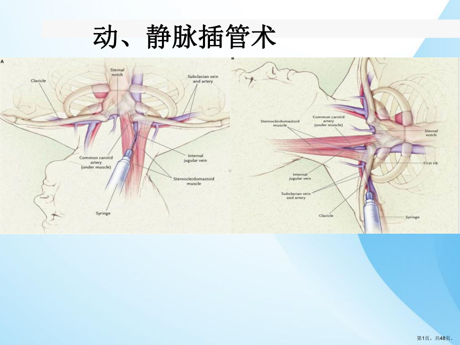 动静脉插管术课件(PPT 48页).pptx_第1页