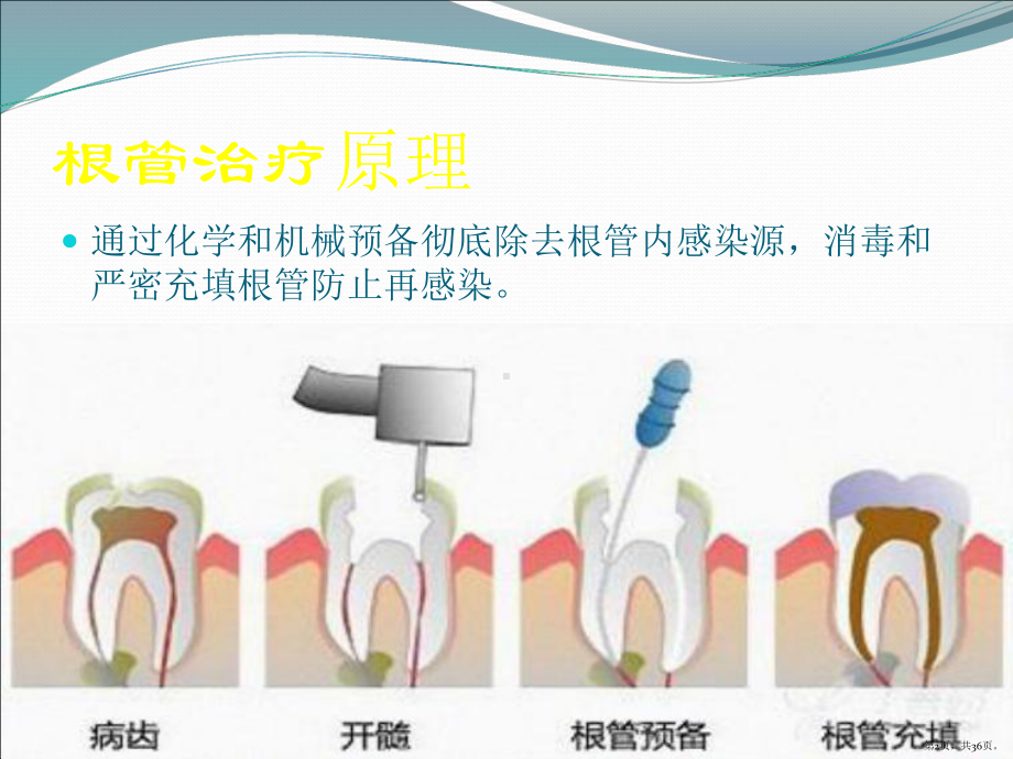 根管治疗临床基础应用课件(PPT 36页).pptx_第2页