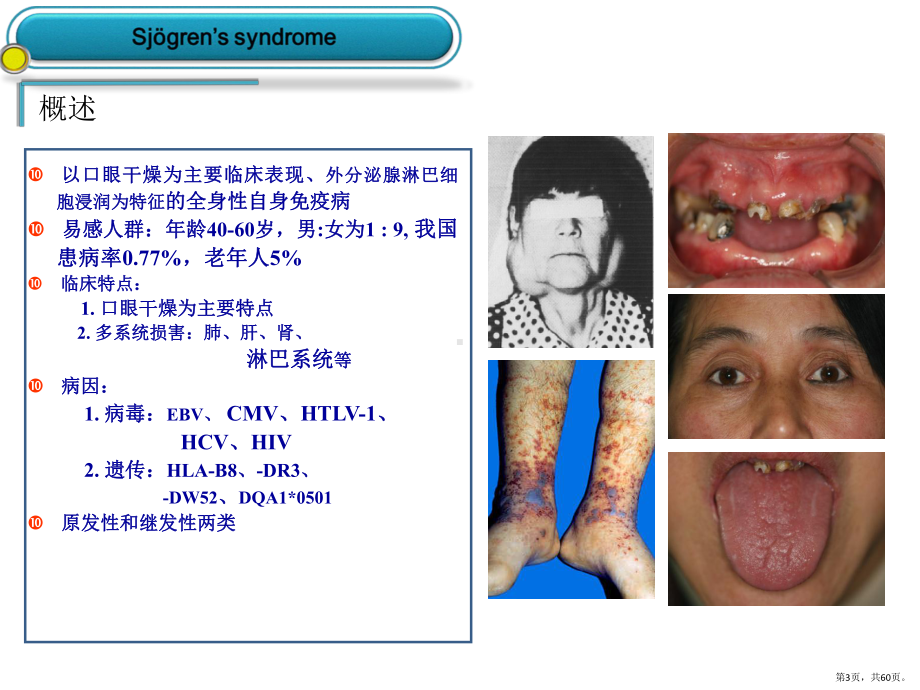 干燥综合征PPT演示课件(PPT 60页).pptx_第3页