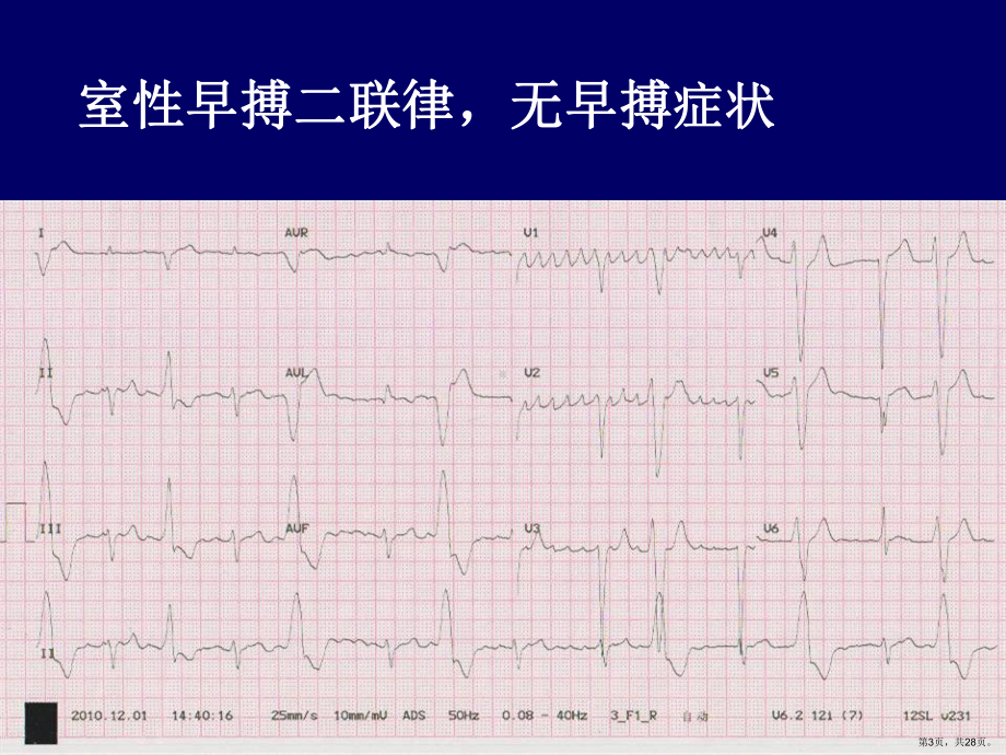 单纯频繁室性早搏应该常规射频消融课件(PPT 28页).ppt_第3页