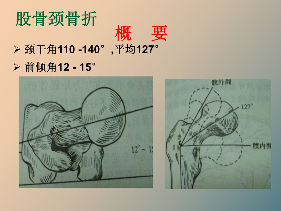 （课件）股骨颈骨折康复.ppt_第2页