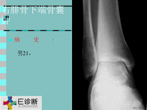 医学影像-骨肿瘤X线病例图谱课件(PPT 257页).pptx