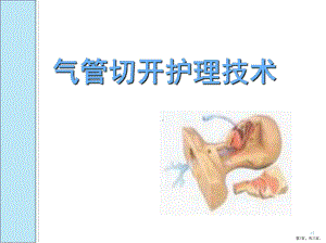 气管切开护理专科护士ppt课件(PPT 33页).pptx