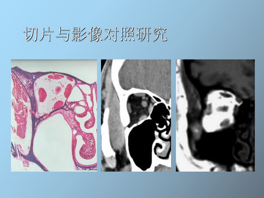 （课件）头颈部肿瘤影像诊断与鉴别.ppt_第3页