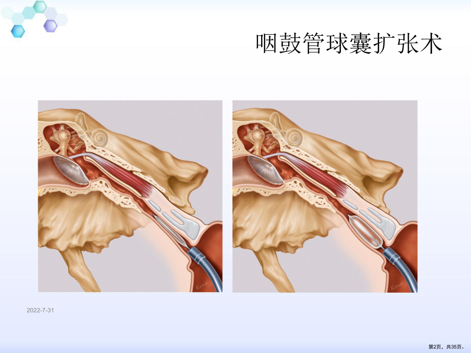 咽鼓管扩张术及全球应用课件(PPT 35页).pptx_第2页