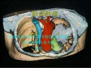 影像系肺部肿瘤课件(PPT 151页).pptx