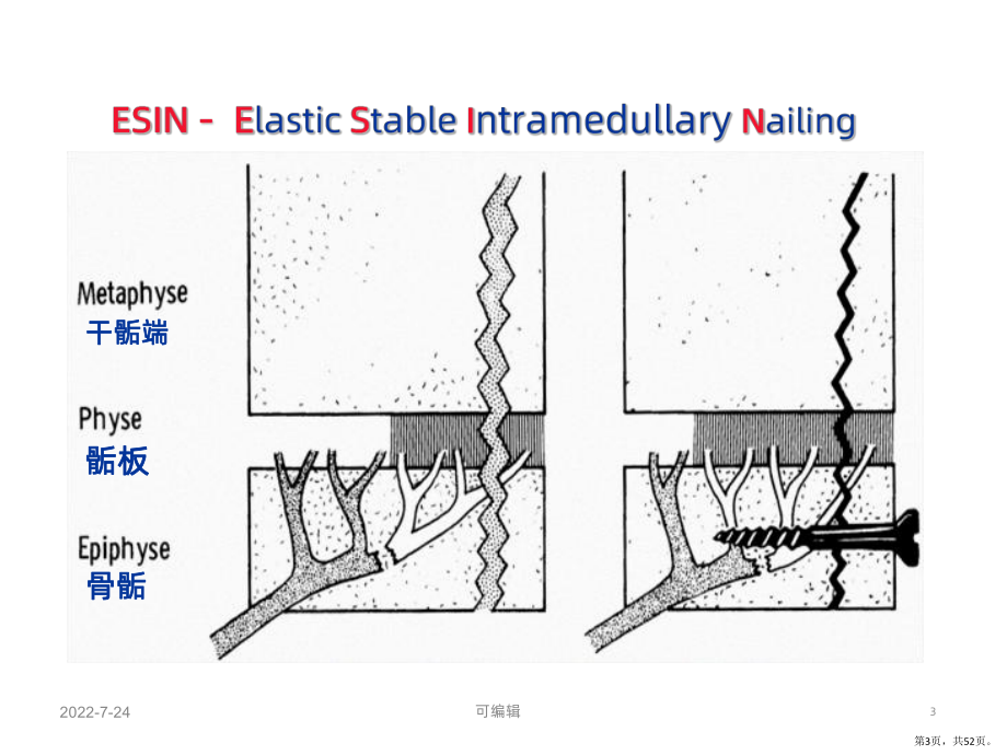 弹性髓内钉治疗儿童长骨骨折-PPT课件(PPT 52页).pptx_第3页