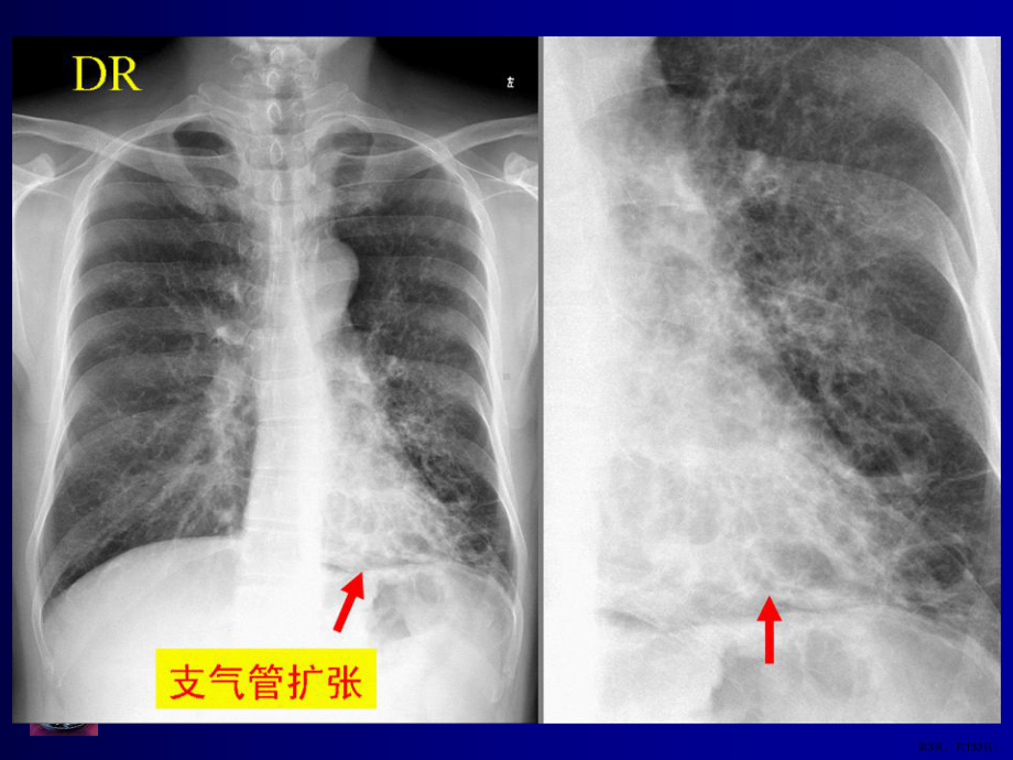 呼吸系统影像诊断课件(PPT 133页).pptx_第3页