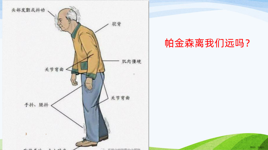 帕金森病的康复PPT课件(PPT 32页).ppt_第3页