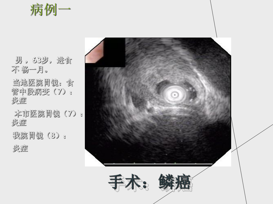 （课件）消化道黏膜隆起性病变的超声内镜诊断备课讲稿.ppt_第2页