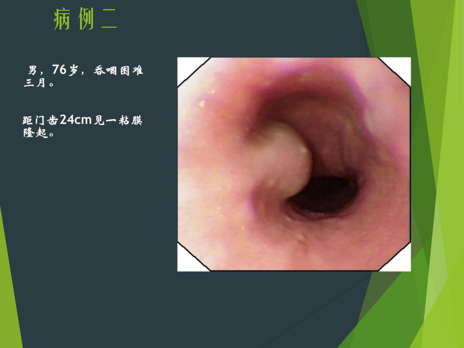 （课件）消化道黏膜隆起性病变的超声内镜诊断备课讲稿.ppt_第3页