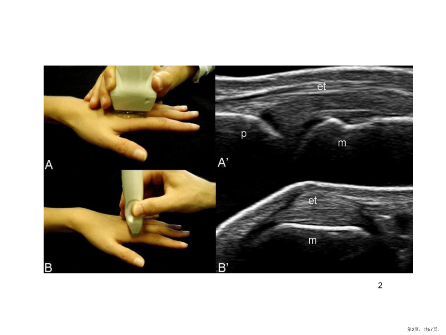 超声影像检查在炎性关节病变中的应用PPT医学课件(PPT 57页).pptx_第2页