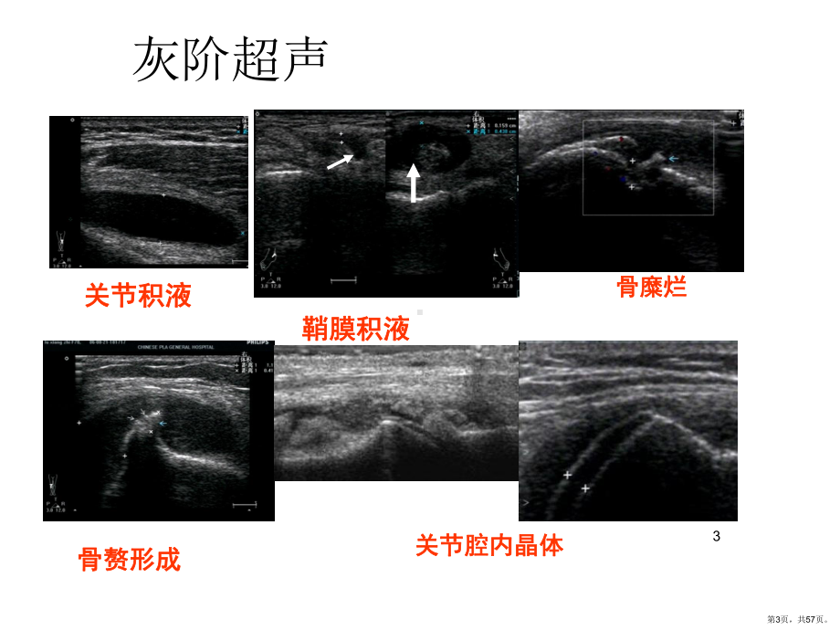 超声影像检查在炎性关节病变中的应用PPT医学课件(PPT 57页).pptx_第3页