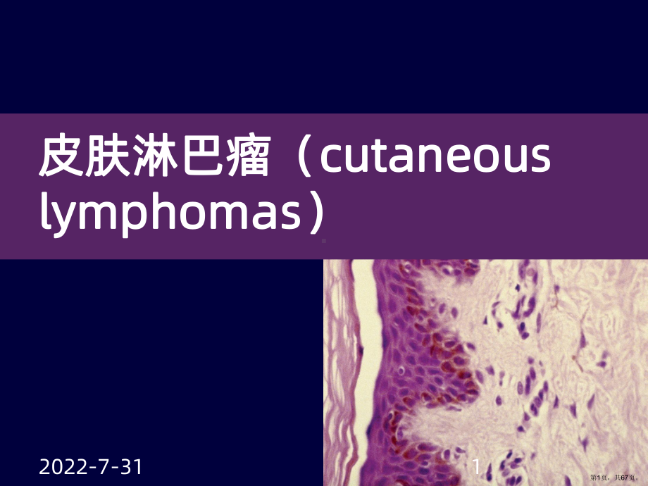 皮肤淋巴瘤诊断和治疗进展PPT课件(PPT 67页).pptx_第1页