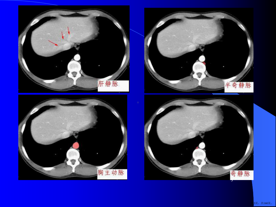腹部CT解剖及常见病诊断PPT课件(PPT 160页).pptx_第3页