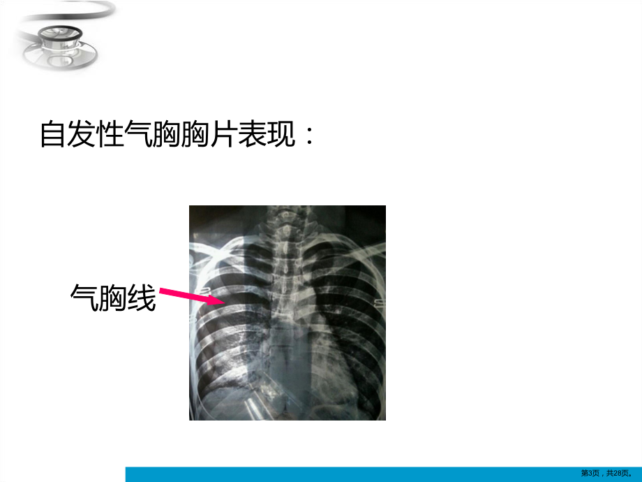 胸外科展板常见病简介课件(PPT 28页).pptx_第3页