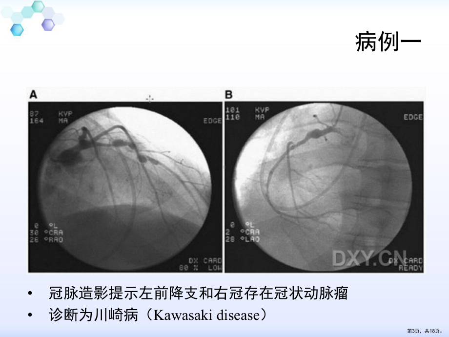 系统性血管炎心血管损害的诊治课件(PPT 18页).pptx_第3页