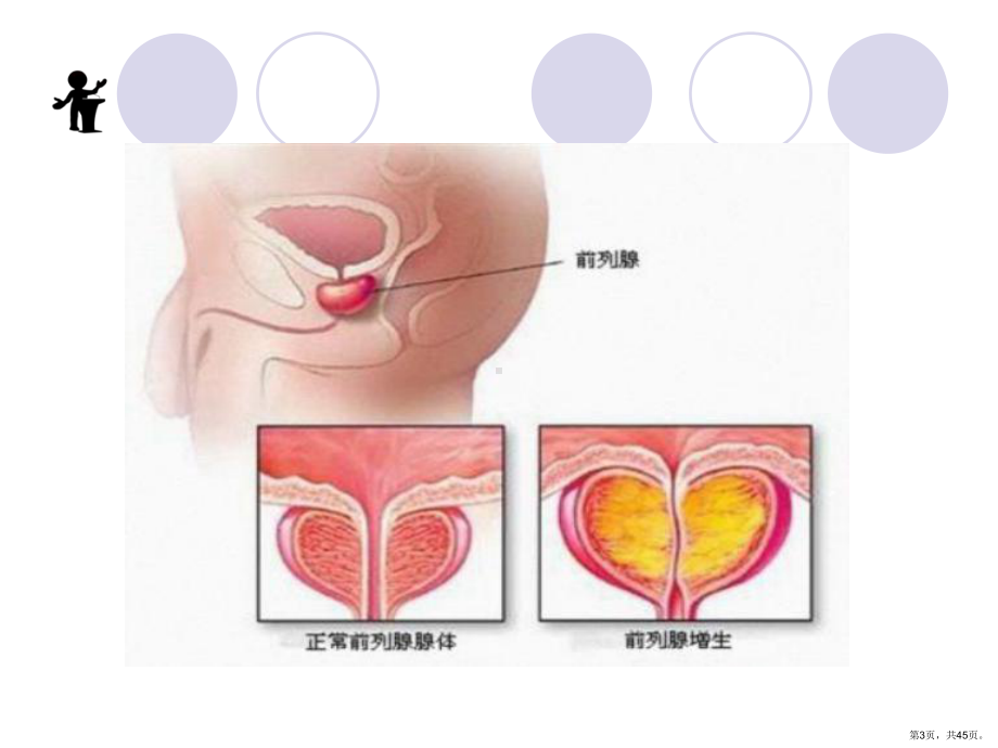 良性前列腺增生病人的护理课件(PPT 45页).pptx_第3页