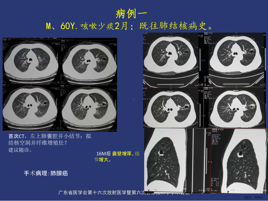 薄壁囊腔型肺癌的影像诊断和鉴别诊断课件(PPT 41页).ppt_第2页