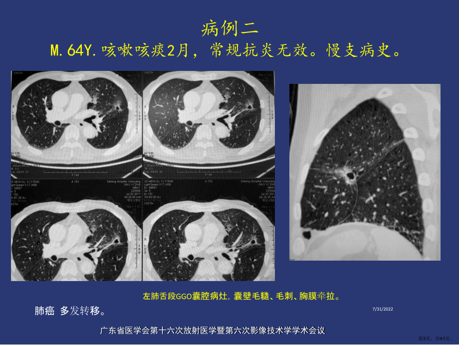 薄壁囊腔型肺癌的影像诊断和鉴别诊断课件(PPT 41页).ppt_第3页