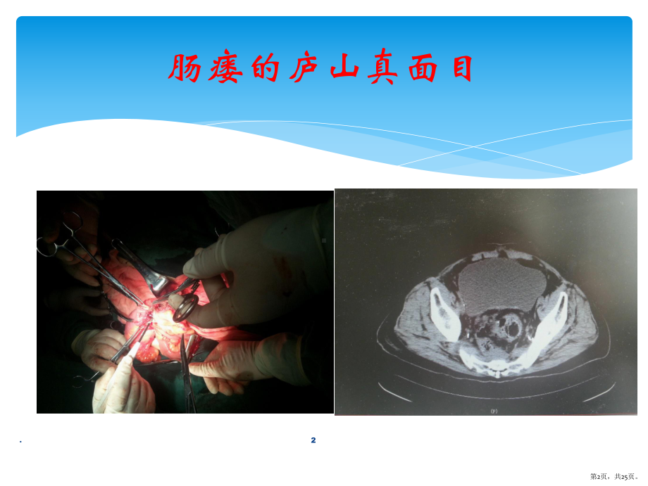 肠瘘治疗PPT医学课件(PPT 25页).pptx_第2页