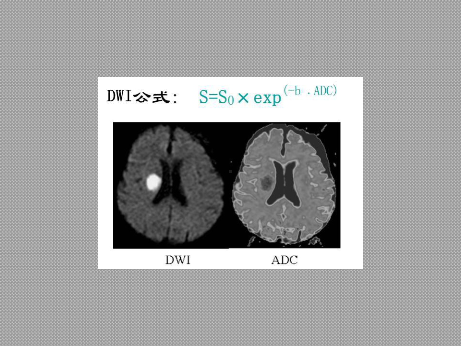 全身类PET肿瘤筛查-磁共振的DWI的参数-44页PPT课件.ppt_第3页