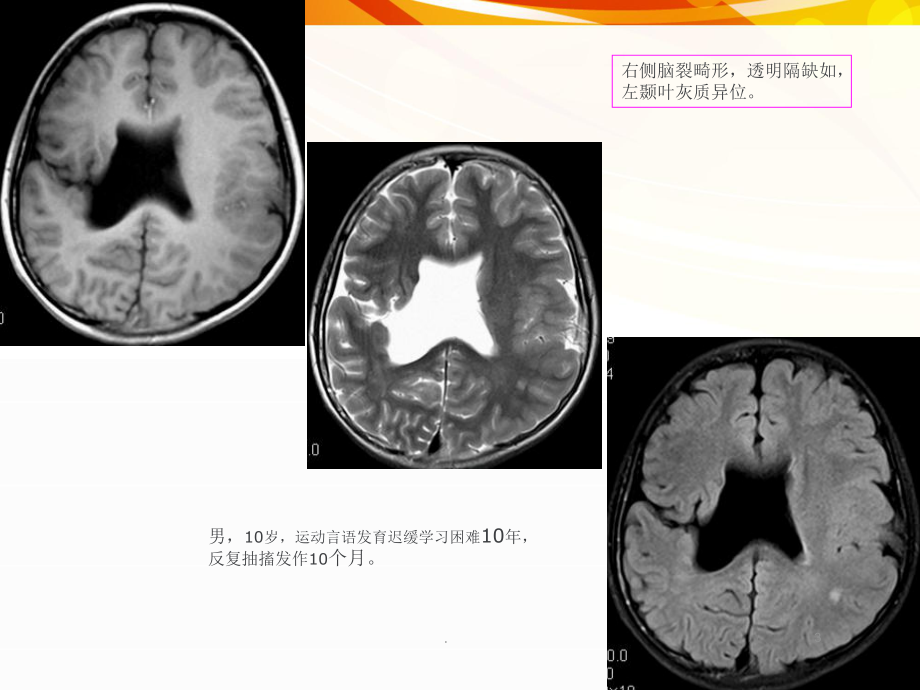 癫痫的MRI及MRSPPT医学课件(PPT 45页).pptx_第3页