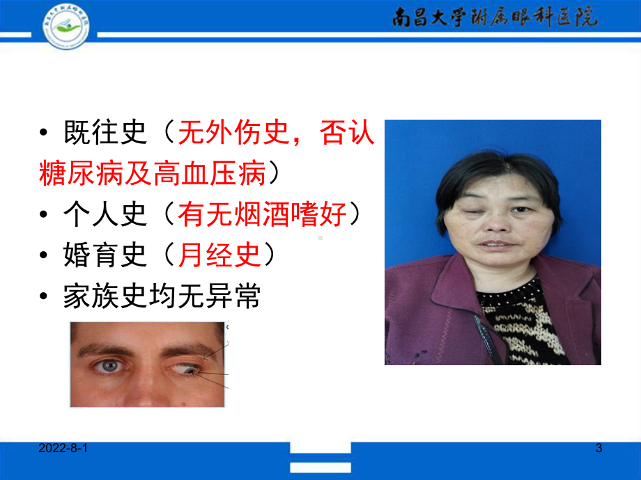 动眼神经麻痹幻灯片课件.ppt_第3页