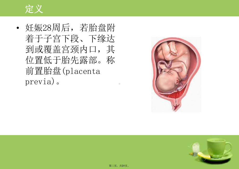 前置胎盘PPT(共31张PPT)课件.pptx_第3页