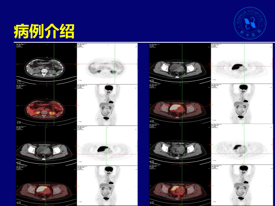 原发性腹膜癌PPT课件.pptx_第3页