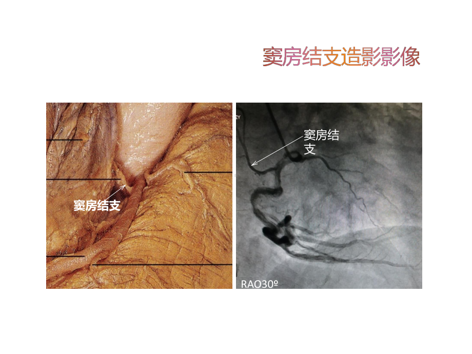 冠状动脉解剖与冠状动脉造影课件2.pptx_第3页