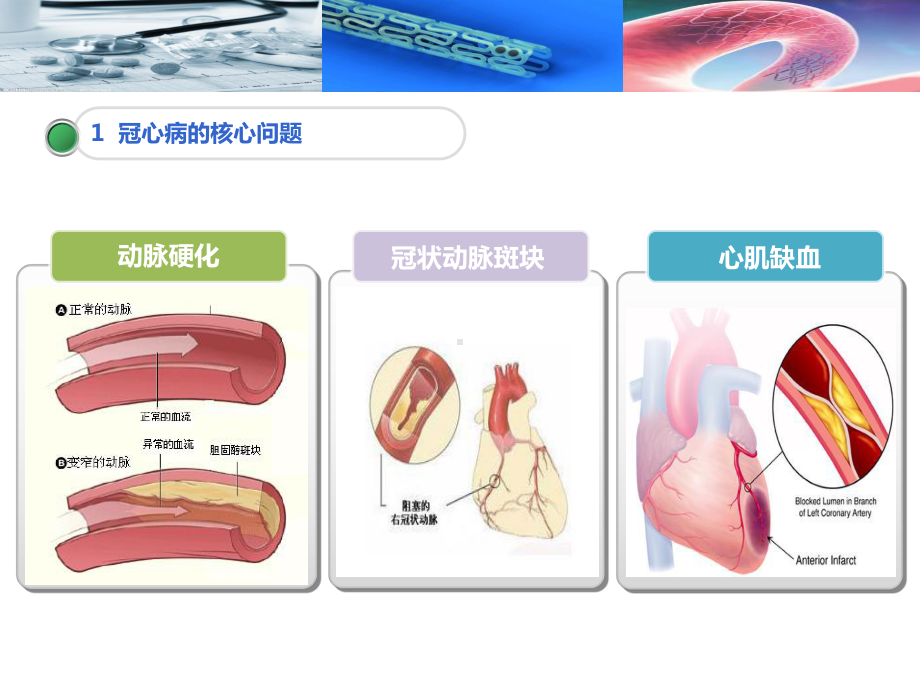 冠心病行pci治疗术课件.ppt_第3页