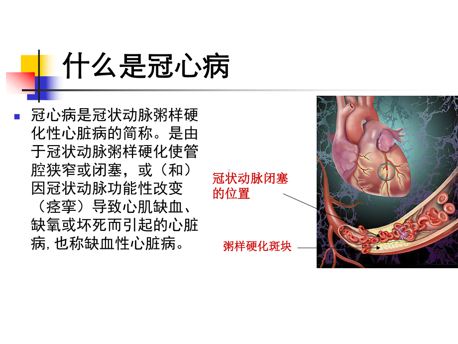 冠心病的分型及治疗课件.ppt_第2页