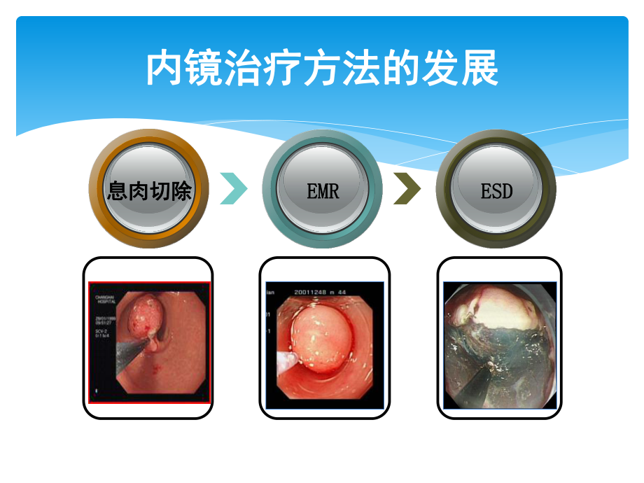 内镜下电凝电切术(新)讲解课件.ppt_第2页