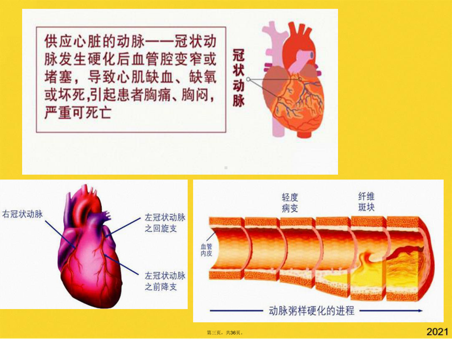 冠心病的康复主要内容(共36张PPT)精选课件.pptx_第3页